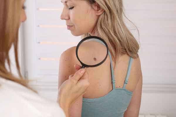 What Are Traditional Skin Lesion Removal Methods East Sussex?
