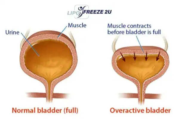 diagram of overactive bladder treatment East Sussex
