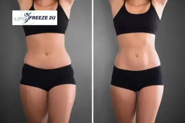 How Can LIPO FREEZE 2U Support Your Post-Pregnancy Body Recovery East Sussex?
