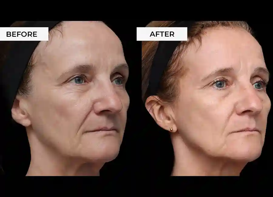 How Many RF Microneedling Sessions Will You Need to See a Difference East Sussex?