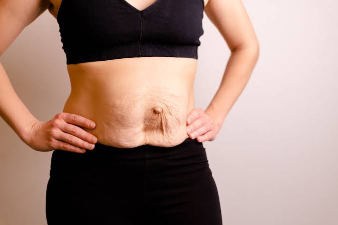 Is Surgery Really the Only Way to Repair Diastasis Recti East Sussex?