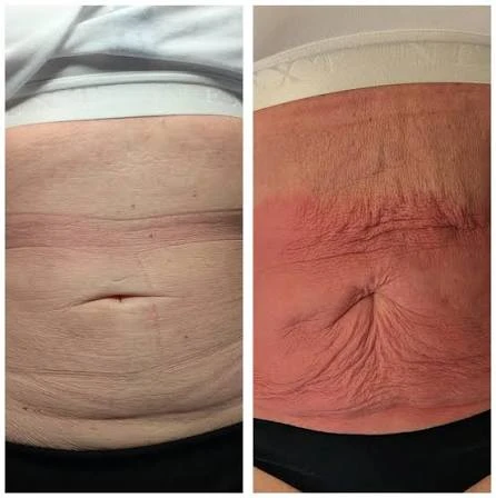 How Does RF Microneedling Improve Crepey, Thin and Uneven Skin Texture East Sussex?