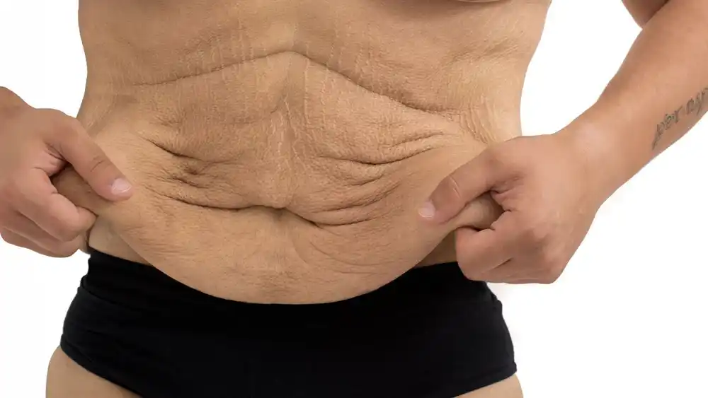 RF Microneedling for Loose Skin: How Can It Help Tighten and Reshape the Skin East Sussex?
